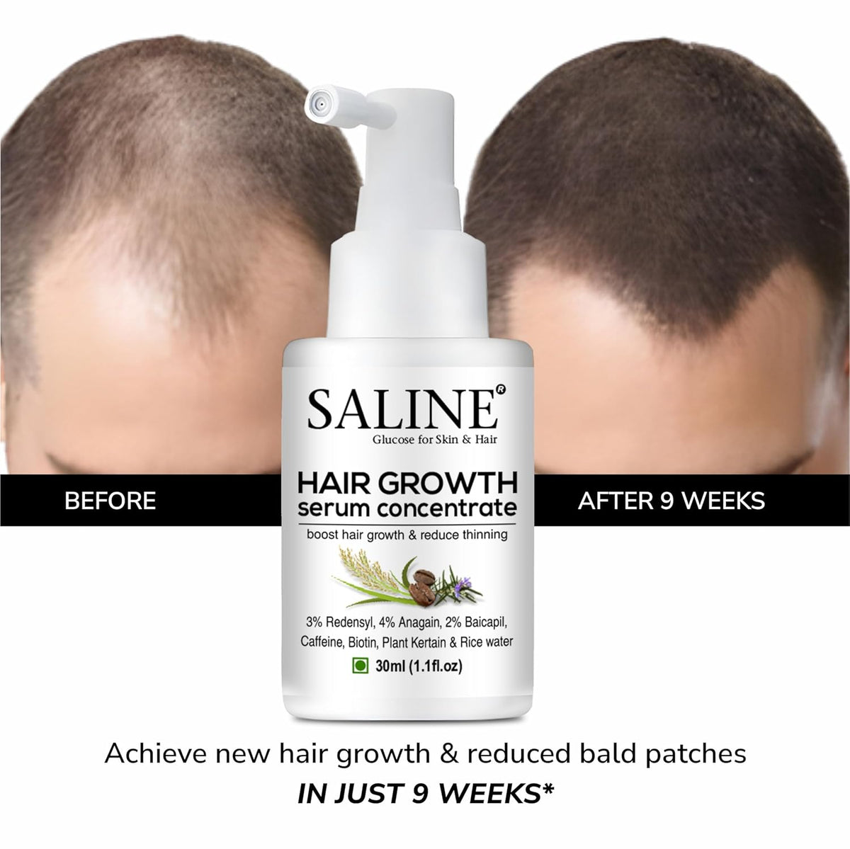 Saline Advanced Hair Growth Serum - Enriched with 3% Redensyl, 4% Anagain, 2% Baicapil, Rosemary, Keratin & Rice Water - Hair Serum For Men & Women (30 ml)