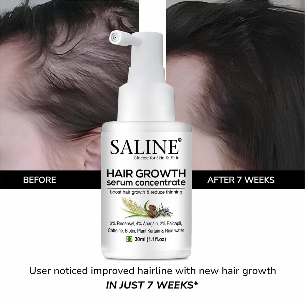 Saline Advanced Hair Growth Serum - Enriched with 3% Redensyl, 4% Anagain, 2% Baicapil, Rosemary, Keratin & Rice Water - Hair Serum For Men & Women (30 ml)